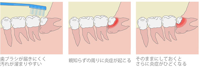 智歯（親知らず）周囲炎にもなりやすい
