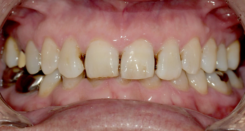 クリーニングの症例