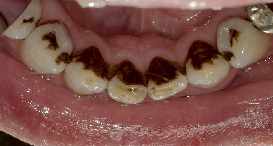 クリーニングの症例