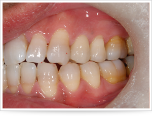 インプラントの症例