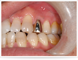 インプラントの症例