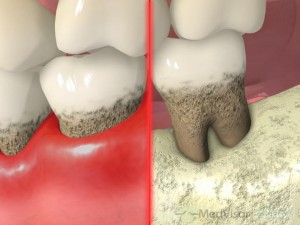 歯周病の進行２