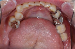 口腔内の部分入れ歯
