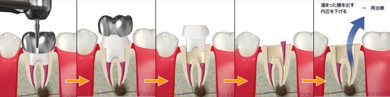 歯根治療の過程1