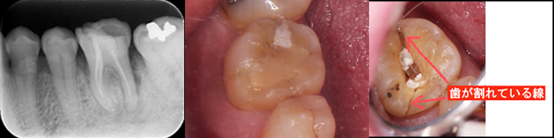 歯根治療の過程1