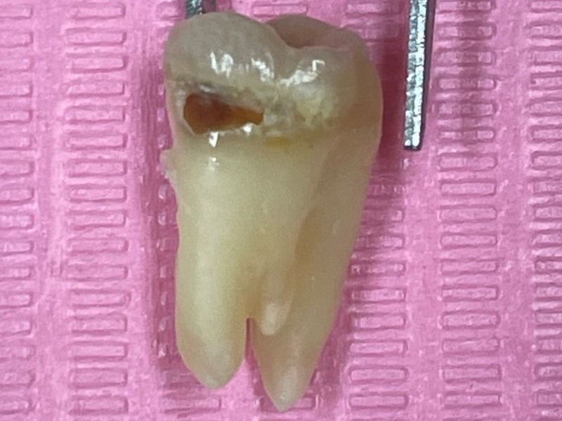 抜去歯の写真①